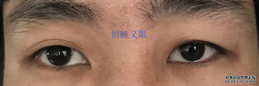 林先生佩戴更換義眼片，保留眼球，眼球萎縮